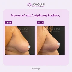 Μειωτική & Ανόρθωση Στήθους | Πριν & Μετά