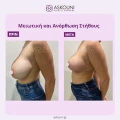 Μειωτική & Ανόρθωση Στήθους | Πριν & Μετά