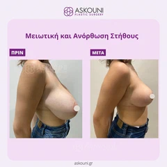 Μειωτική & Ανόρθωση Στήθους | Πριν & Μετά