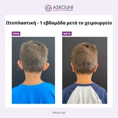 Ωτοπλαστική - Παιδί | Πριν & Μετά