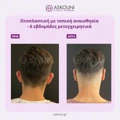 Ωτοπλαστική - Άνδρας | Πριν & Μετά