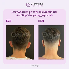 Otoplasty - Male | Before & After
