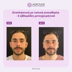 Ωτοπλαστική - Άνδρας | Πριν & Μετά