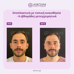 Otoplasty - Male | Before & After