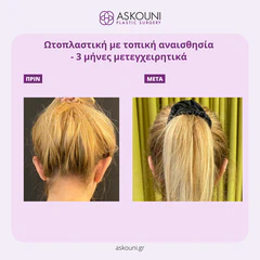 Otoplasty - Female | Before & After