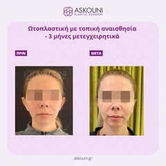 Ωτοπλαστική - Γυναίκα | Πριν & Μετά