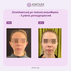 Otoplasty - Female | Before & After
