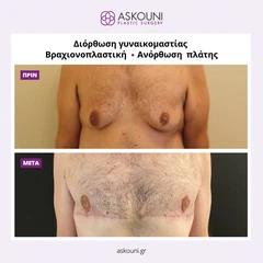Πλαστική μετά από Απώλεια Βάρους | Πριν & Μετά