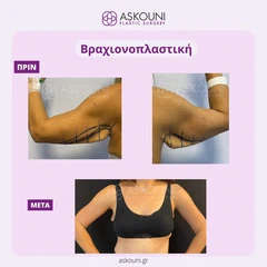 Βραχιονοπλαστική - Γυναίκα | Πριν & Μετά