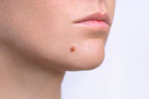 Excision of Moles