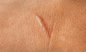 Keloid Scars Treatment