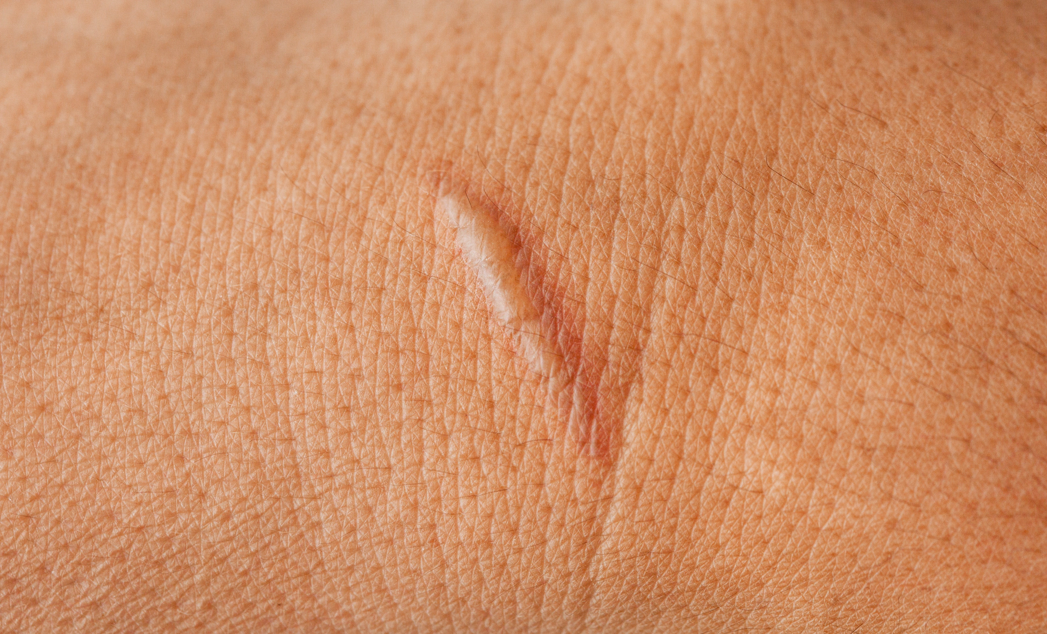Keloid Scars Treatment