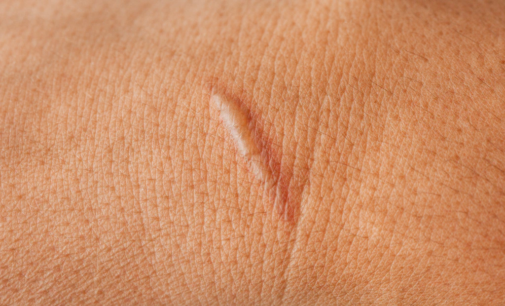 Keloid Scars Treatment