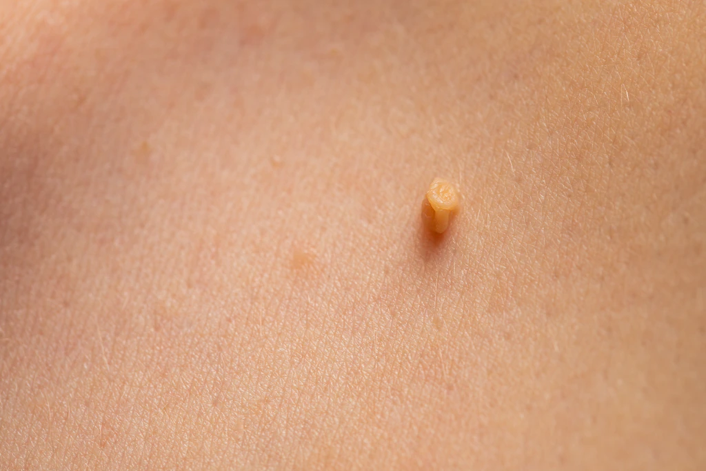 Removal of Skin Tags (Papillomas)