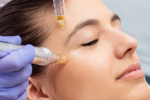 Μεσοθεραπεία με Dermapen
