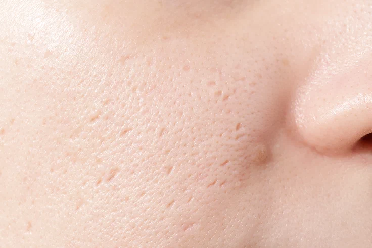 Ουλές Ακμής - Microneedling / Dermapen